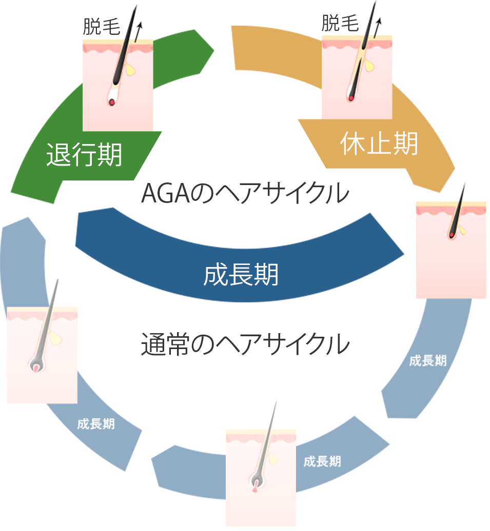 AGAの進行メカニズム