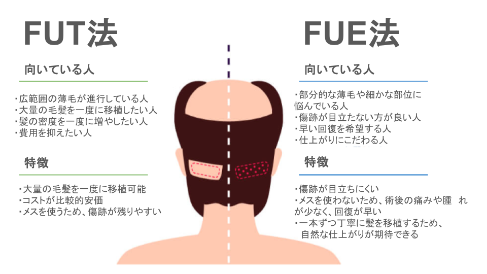 FUT法とFUE法の比較表