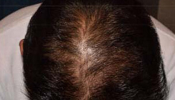 頭頂部の自毛植毛後の症例写真
