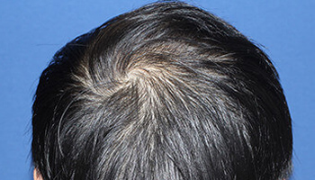 頭頂部の自毛植毛後の症例写真