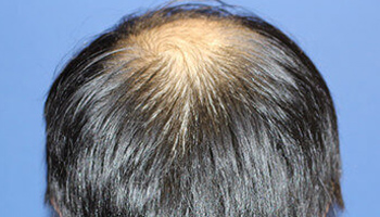 頭頂部の自毛植毛前の症例写真
