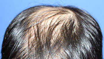 頭頂部の自毛植毛前の症例写真