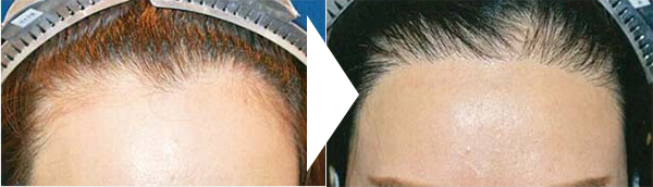 自毛植毛によるヘアライン設計の術前術後の写真