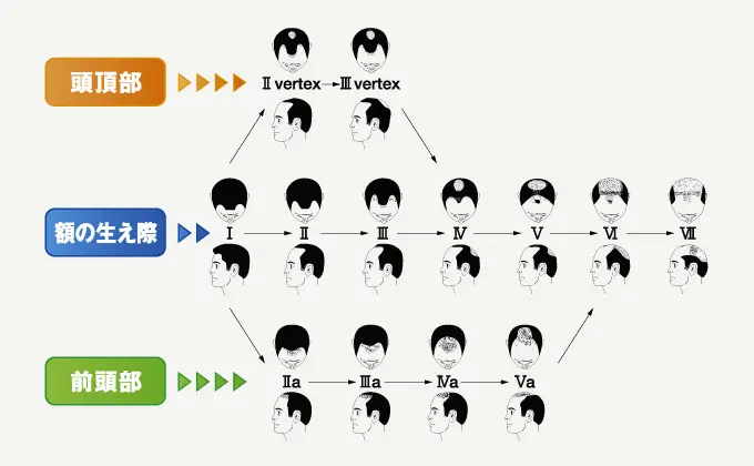 AGAかどうかの見分け方は？セルフチェック・診断方法を解説