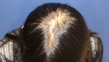 びまん性脱毛症 とは何でしょうか 治療法はありますか 親和クリニックのドクターが自毛植毛の疑問を解決