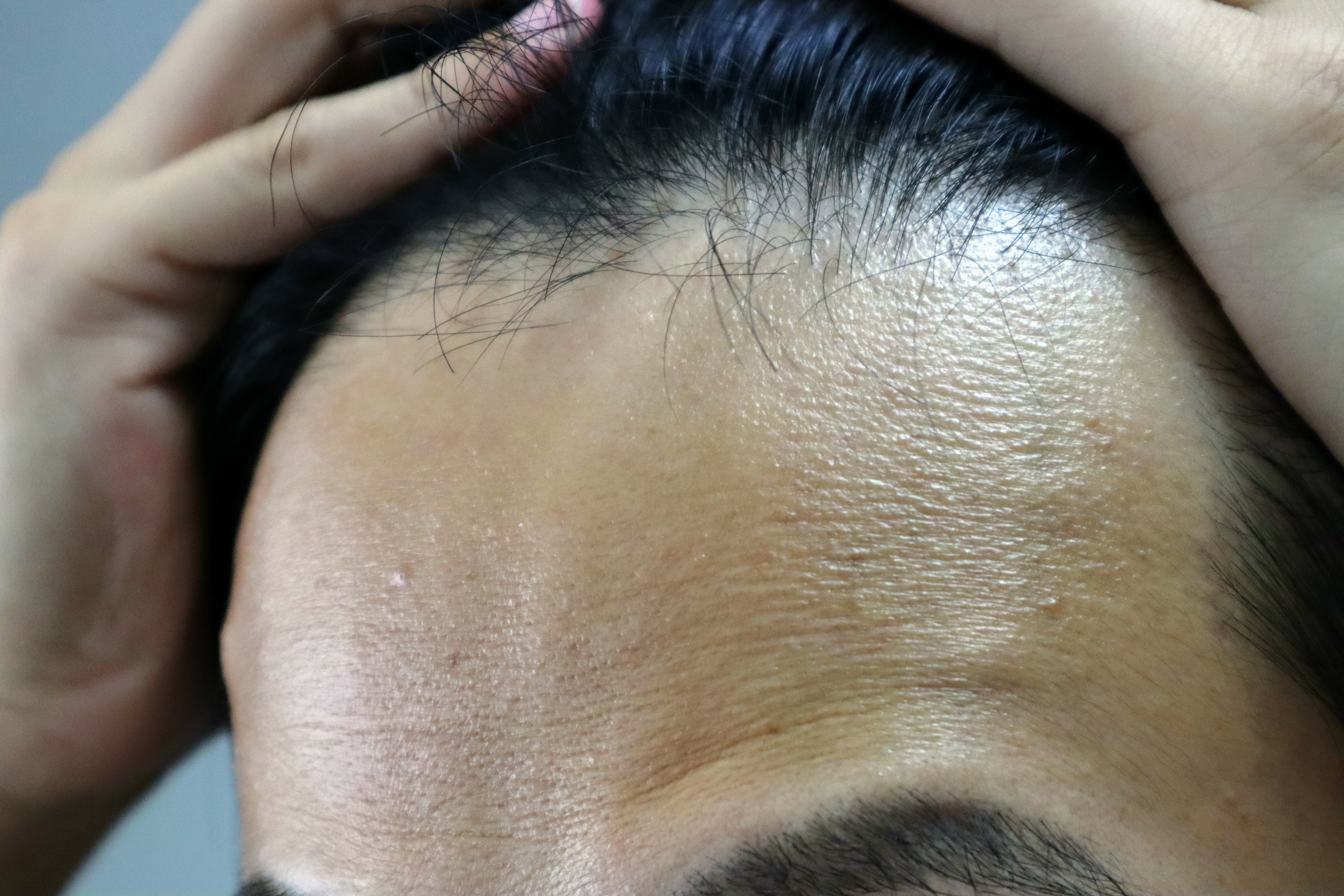 ハゲ・薄毛の原因になるのは「ジヒドロテストステロン(DHT)」